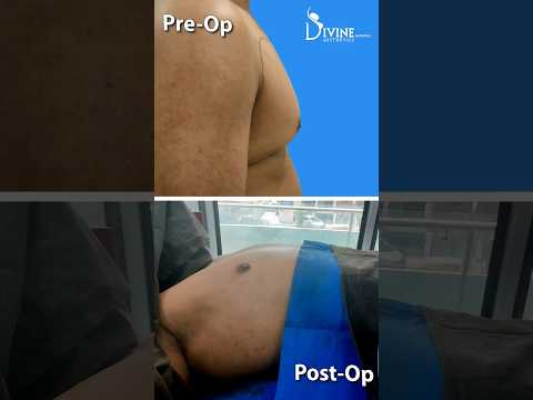 Gynecomastia 360° 4Dx Technique: Male Breast Reduction Grade 2A Surgery Result