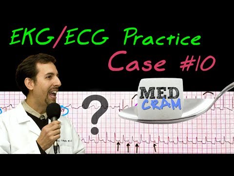 12 Lead ECG Practice Strip Interpretation - EKG Case 10