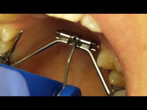 How to Turn Your Palatal Expander: Explanation and Patient Demonstration from The Ranch Orthodontics