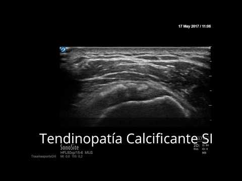 TENDINOPATÍA CALCIFICANTE HOMBRO BARBOTAJE ECOGUIADO