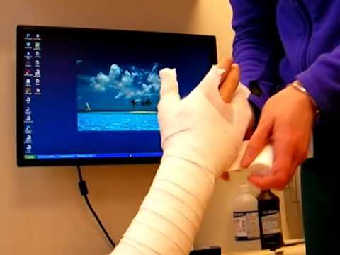 How to Make a Cast for a Hand Fracture - Nicky Leung, MD