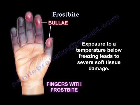 Frostbite UPDATE - Everything You Need To Know - Dr. Nabil Ebraheim