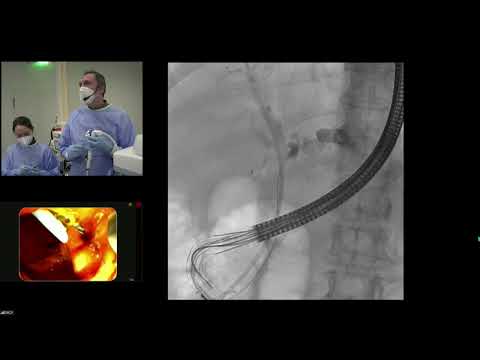 DGEBV Online Sendung VIII - 02.02.2022: Fokus ERCP - Live Fälle