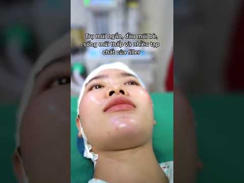 #rhinoplasty #asianrhinoplasty