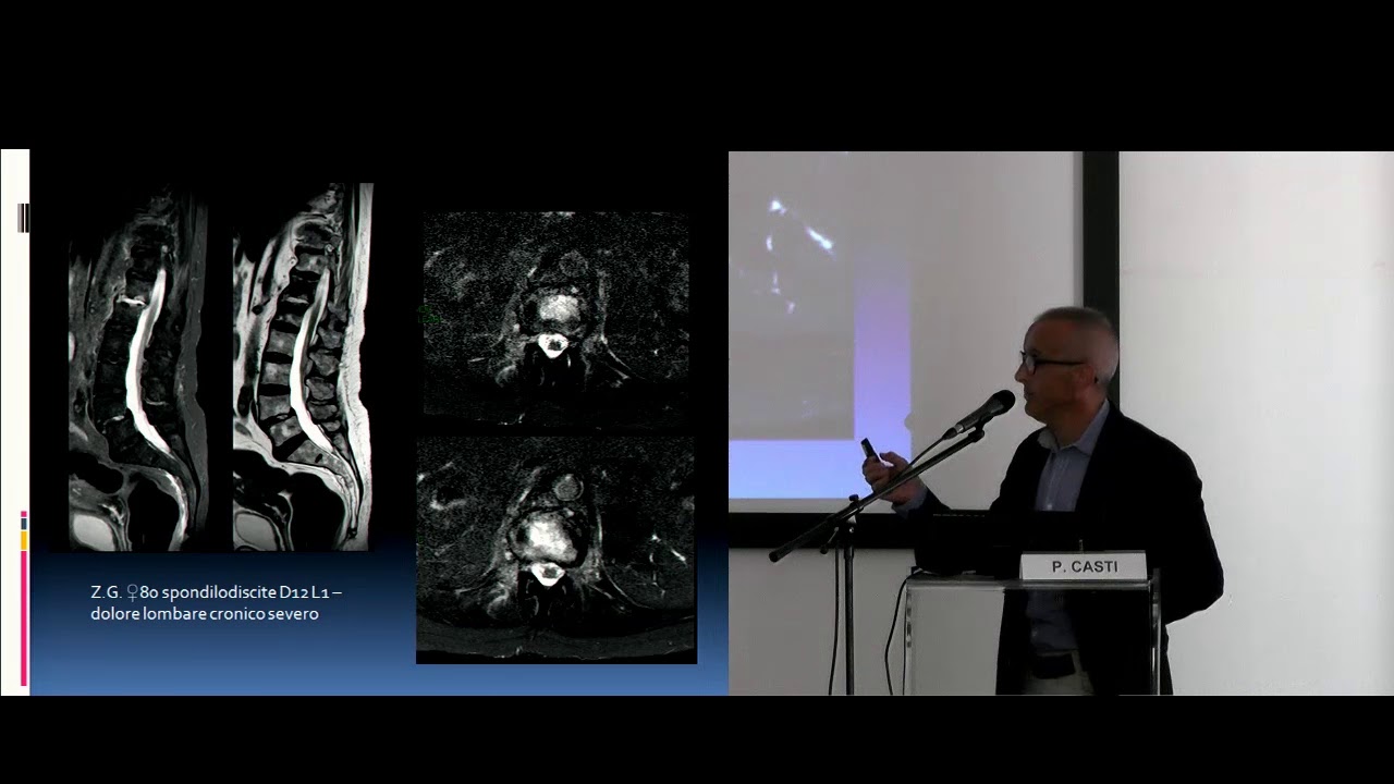 Watch Now La peridurale antalgica nella patologia del rachide: something new La peridurale antalgica nella patologia del rachide: something new