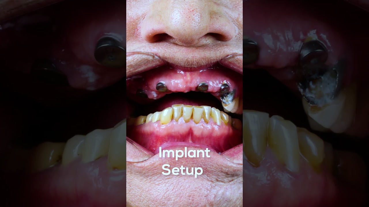 نتائج مذهلة لزراعة الأسنان: تجربة مريضة قبل وبعد الإجراء