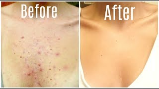 How I Got Rid Of My Body Acne FOREVER!