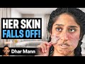Girl Whose SKIN FALLS OFF Dhar Mann Studios