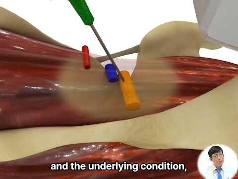 Suprascapular nerve injection for shoulder pain