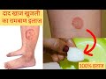 पुराने व भयंकर दाद खाज खुजलीको जड़ से 2 