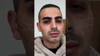 JAW, CHEEK FILLER #jawfiller #mensjaw #filler #facialaesthetics #cheekfiller #makeup #gay #fillers