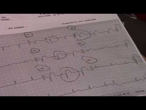 📎 Electrocardiogram in ACUTE MYOCARDIAL INFARCTION 🫀