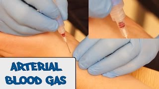 Arterial Blood Gas Sampling (ABG) - OSCE Guide (Old Version)