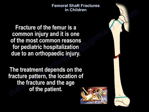 Femoral Shaft Fracture in Children - Everything You Need To Know - Dr. Nabil Ebraheim