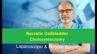Miniaturka - Necrotic Gallbladder. Cholecystectomy. Metin Ertem MD.FACS.