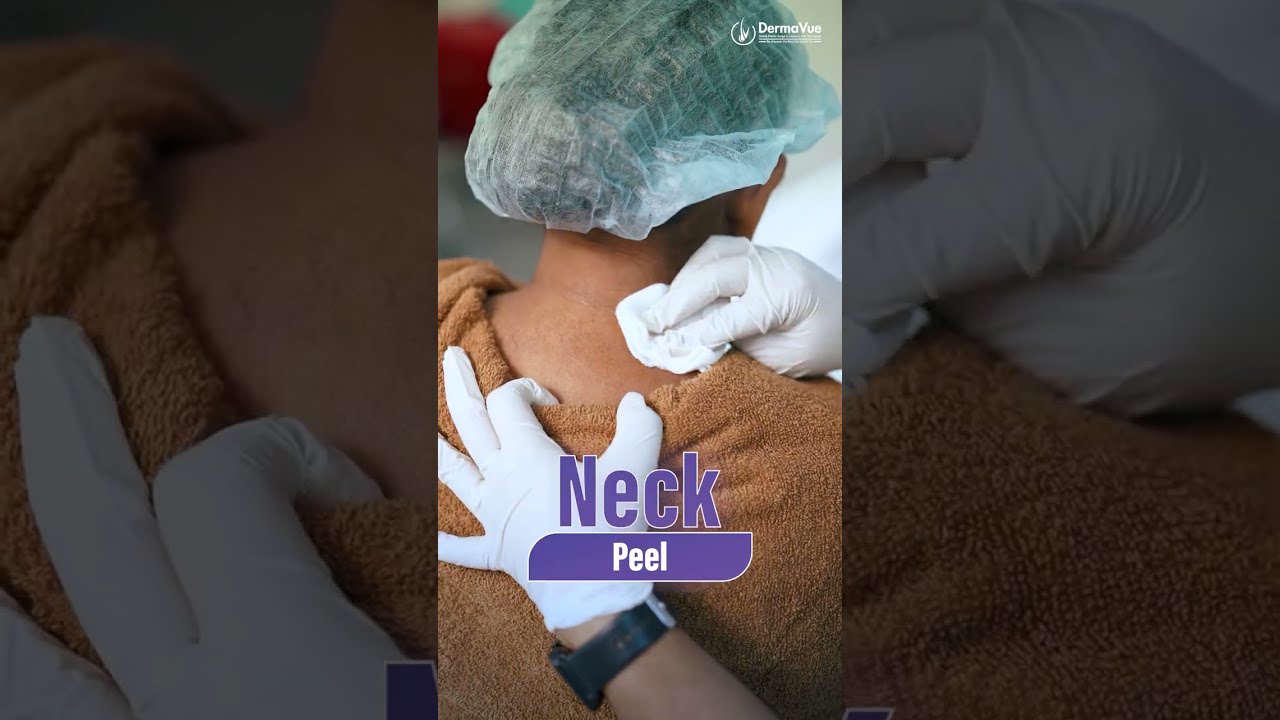 Neck Pigmentation? Here's What Actually Works #pigmentation #peels #skincare
