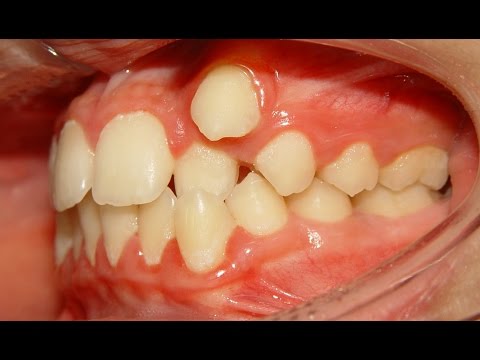 Orthodontic Treatment of Ectopic Upper Canine - No Extraction (Salah 12yrs)