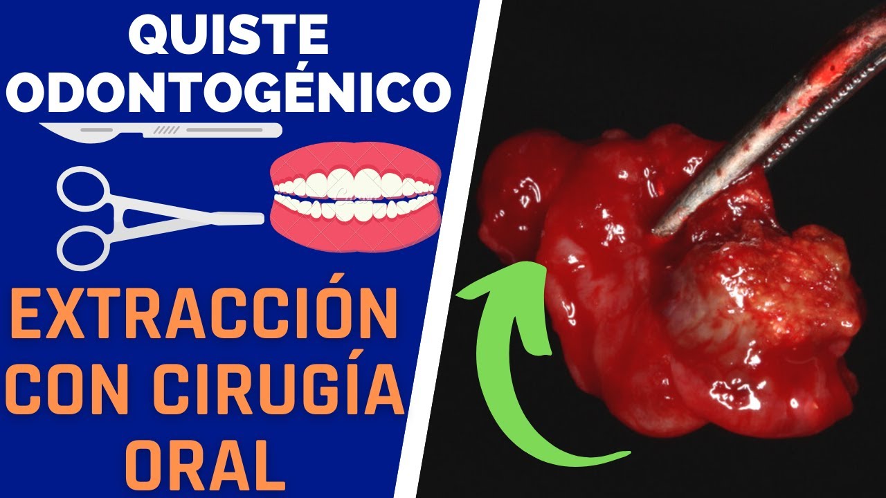 Eliminación de QUISTE ODONTOGENICO mediante cirugía - Quiste en los DIENTES