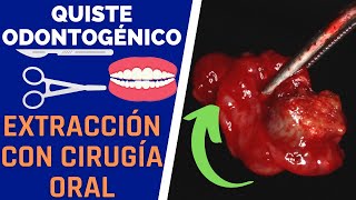 Eliminación de QUISTE ODONTOGENICO mediante cirugía - Quiste en los DIENTES