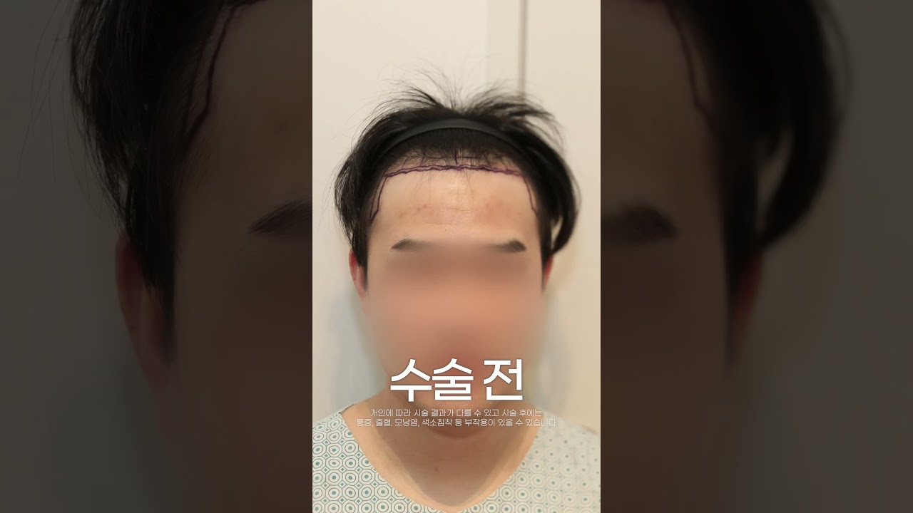 M字脱发 头顶脱发 以种发的方式填满了头发