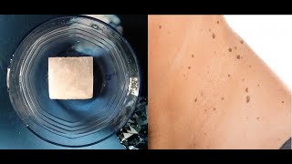 how to remove moles permanently at home/ best mole removal method