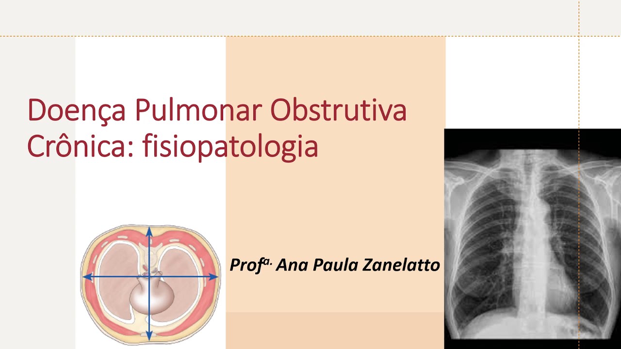 Doença pulmonar obstrutiva crônica: fisiopatologia