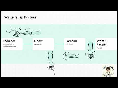 Clinical Diagnosis of Erb-Duchenne Palsy: USMLE