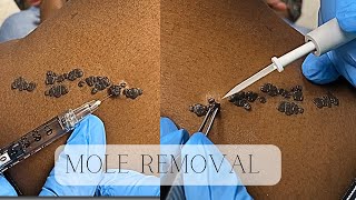 MOLE REMOVAL | REMOVING UNWANTED MOLE | DERMATOLOGIST MEDSPA