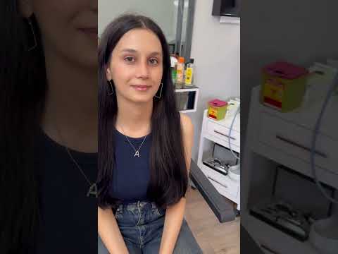 Nose Job in Turkey - 3 weeks later - Bursa Rhinoplasty - Dr Özlem Oymak