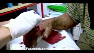 Bizarre hand injury broken bones skin flappying, EndOfNumbers