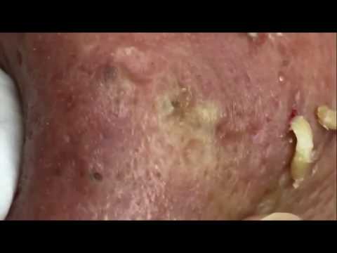 extraccion espinillas