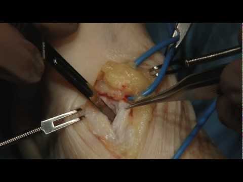 Sacro Lendenwirbel Osteochondrose Übungsvideos Drogen Gelenkknorpel wiederherstellen