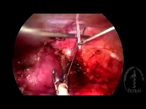 Single-Port Nephrectomy - Ureter Retraction
