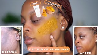 How To Get Rid Of Sunburn At Home With Turmeric | RuthK