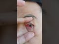 Konjungtivitis Akut Mata Merah Muda Alergi Bakteri Viral Contoh Akibatnya Shorts