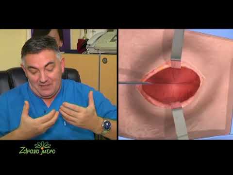 Plasticna i Estetska Hirurgija, Zdravo Jutro, ass. mr. sci. med Milomir Gacevic