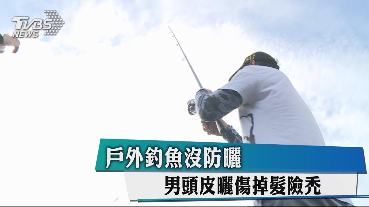 戶外釣魚沒防曬 男頭皮曬傷掉髮險禿