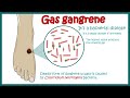 Gas Gangrene Clostridial Myonecrosis Symptoms And Treatment Of Gas Gangrene