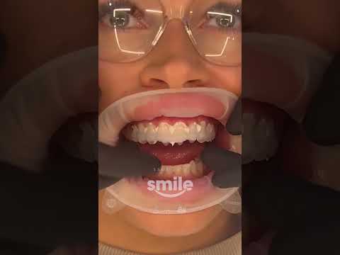 Porcelain Veneers 🤩 #dentist #smilemakeover #smiledentist