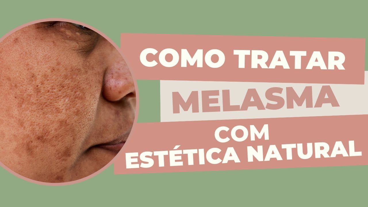 Como tratar Melasma com Estética Natural