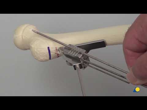 Femur, Proximal—Valgus Deformity—Varus Osteotomy and Fixation Using the LCP Pediatric Hip Plate