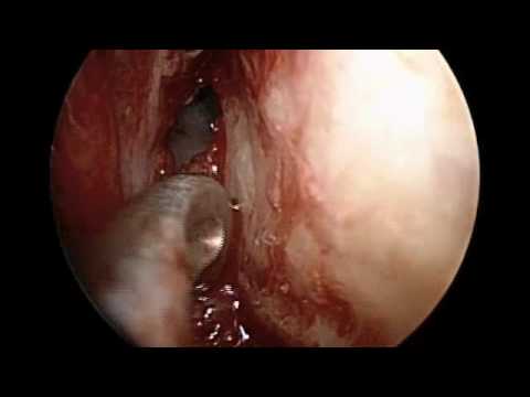 Skull Base Reconstruction - Transnasal Repair