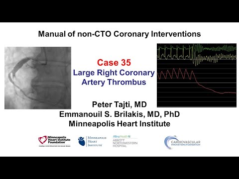 Case 35: PCI Manual- Large RCA thrombus