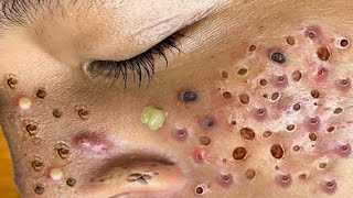 Loan Nguyen Acne Treatment 27n
