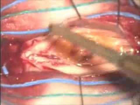 Segni di danni ai legamenti del ginocchio Diminuzione vertebre della colonna vertebrale cervicale