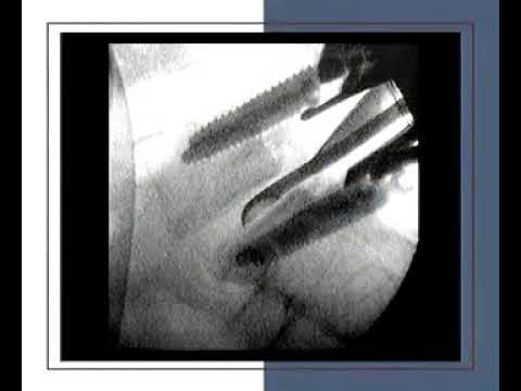 Trans-foraminal intrebody fusion (TLIF) of L4-L5