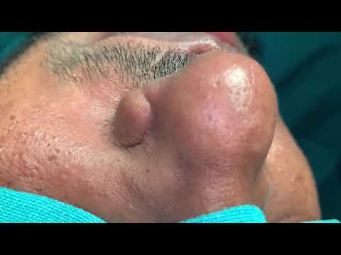 Scar Removal On The Alar Part Of The Nose