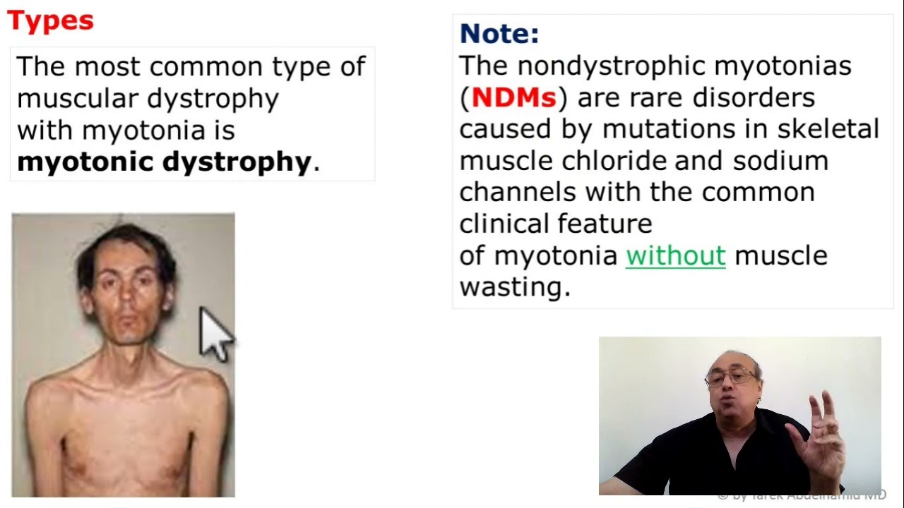 Myotonia