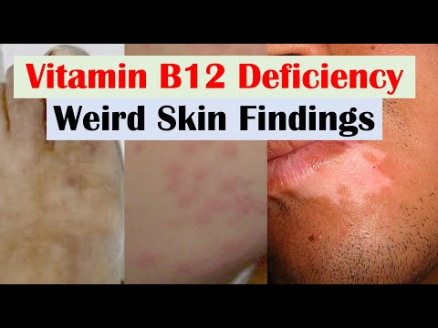 Vitamin B12 Deficiency Weird Skin Findings (& Hair and Nails)