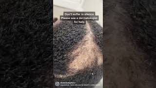 Hair loss/ Alopecia Help